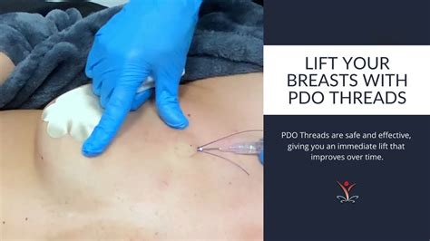 A thread lift is a type of procedure wherein temporary sutures are used to produce a subtle but visible "lift" in the skin. . Aptos thread breast lift before and after
